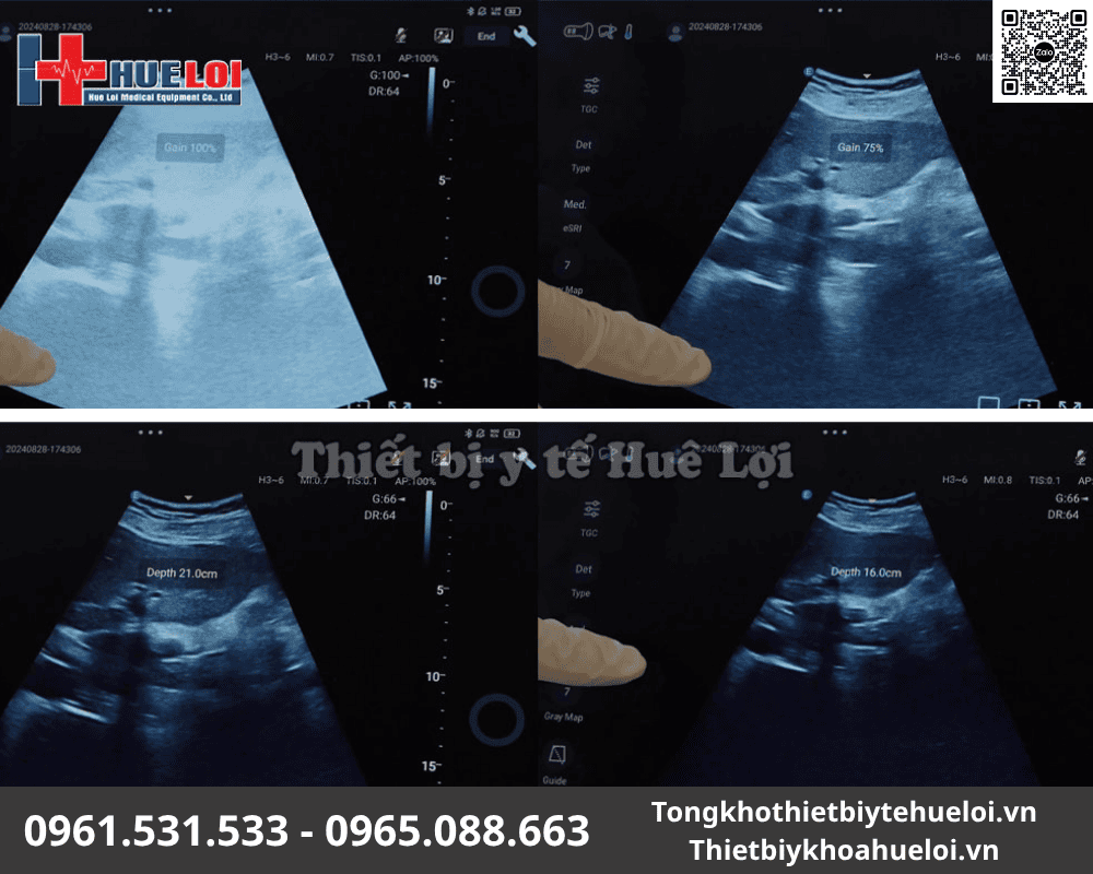 thiết bị siêu âm bỏ túi