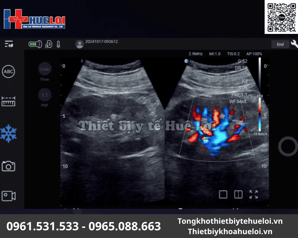 chất lượng hình ảnh siêu âm